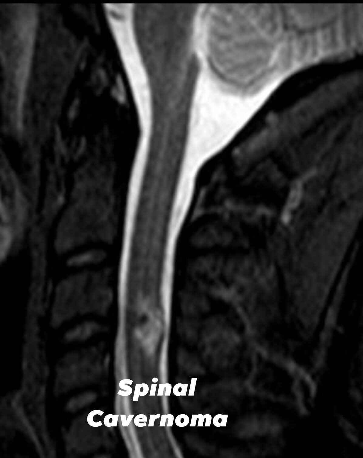 Treatment for Cavernous malformations is within our reach image